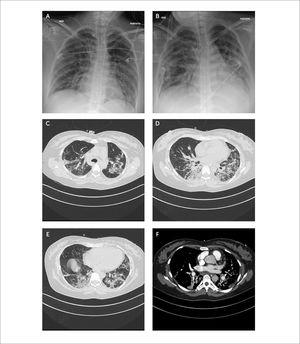 Imágenes radiográficas y de angio-TAC de tórax. Embarazada de 25 semanas con COVID-19 y neumopatía bilateral Imágenes radiográficas de tórax portátil (A-B). A) Se observan áreas de relleno alveolar bilaterales, con pérdida de volumen, que predominan en el tercio inferior de ambos pulmones. B) Progresión de las áreas de relleno alveolar bilaterales en comparación imagen A. Imágenes de angiografía TAC de tórax (C-F). C-E) Ambos pulmones con áreas en vidrio esmerilado (“glass ground”) características, asociadas a imágenes de empedrado (“crazy paving”) y engrosamiento intersticial bilateral que predominan en tercio medio e inferior y bases de ambos pulmones, asociadas a perdida de volumen. F) Imagen de mediastino, no hay evidencia de TEP. Se observan rellenos vasculares redondeados normales de la vasculatura pulmonar.
