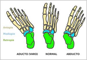 Deformidades del pie en el plano antero-posterior (AP). Desplazamiento a medial o lateral del antepié (metatarsos) en relación al retropié.
