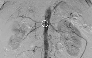 Por la vía de la arteria femoral izquierda se realiza aortograma y arteriografía selectiva de la arteria renal derecha, apreciando estenosis significativa del ostium.