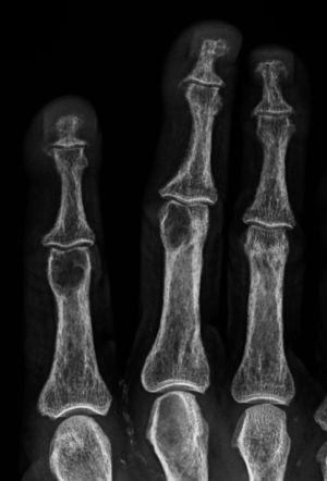 Radiografía de manos en proyección anteroposterior de un paciente de 31 años portador de enfermedad renal crónica e hiperparatiroidismo, donde se observan zonas de resorción ósea subperióstica en el borde radial de las falanges medias de los dedos índice, medio y anular.