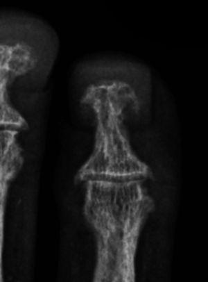 Radiografía con aumento del mismo paciente, donde se observa acroosteólisis de la falange distal del dedo anular.