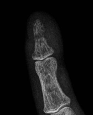 Radiografía con aumento donde se evidencia acroosteólisis en banda a nivel del tercio medio de la falange distal del dedo meñique derecho.