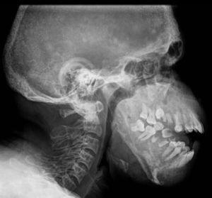 Radiografía de columna cervical en proyección lateral de un paciente con antecedentes de hiperparatiroidismo secundario e insuficiencia renal crónica. Se aprecia esclerosis alternada con áreas radiolúcidas a nivel de los huesos de la bóveda craneana, adoptando un patrón en «sal y pimienta».