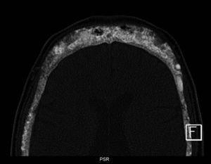 Corte seleccionado de tomografía computarizada del mismo paciente que muestra un extenso compromiso de la calota, con un patrón de densidad ósea de aspecto granular, donde además se observa la presencia de múltiples lesiones líticas.