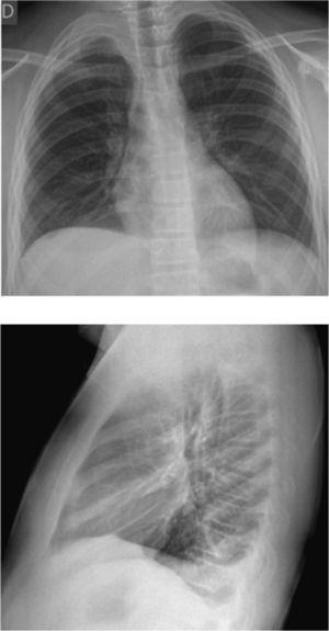 Radiografía de tórax AP-L. Leve derrame pleural derecho e imagen apical derecha sugerente de engrosamiento pleural.