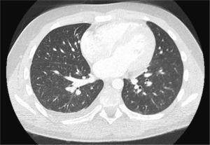 Corte axial de TC de tórax con ventana pulmonar. El parénquima pulmonar no presenta imágenes patológicas.