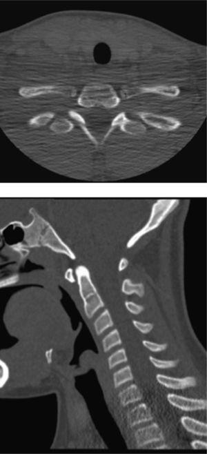 Corte axial y reconstrucción sagital de TC de cuello en ventana ósea. Estructura ósea normal, sin hallazgos patológicos.