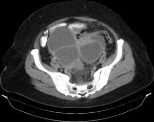 TC de abdomen y pelvis con contraste endovenoso en fase portal y contraste oral positivo. Corte axial. Lesiones quísticas pared y tabiques engrosados, con discreto realce.