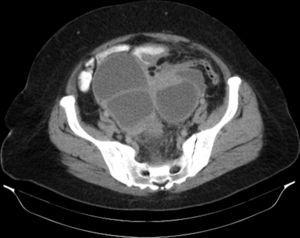 TC de abdomen y pelvis con contraste endovenoso en fase portal, y contraste oral positivo. Corte axial. Lesiones quísticas de pared y tabiques engrosados, con discreto realce.