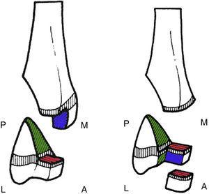 En (a) se ilustra la FT de 2 fragmentos y en (b) la de 3 fragmentos. En verde rasgo coronal, en azul rasgo sagital y en rojo rasgo transversal. A: anterior; P: posterior; M: medial; L: lateral. Fuente: adaptado de MacNealy et al.5.