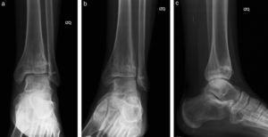Control a la semana n.o 50 del paciente de la figura 3, donde se evidencia la consolidación de los rasgos de fractura. El paciente recibió solamente tratamiento ortopédico.