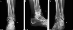Radiografía de tobillo izquierdo en proyecciones AP (a), lateral (b) y oblicua o mortaja (c) de un paciente varón de 14 años. Se observa una FT.