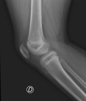 Enfermedad de Sinding-Larsen-Johansson. Proyección lateral de radiografía. Pequeño fragmento óseo en el polo inferior de la patela, asociado a engrosamiento del tendón patelar.