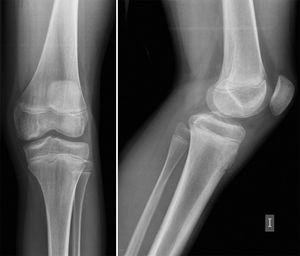 Osteocondritis disecante juvenil. Radiografía AP y lateral. Defecto osteocondral radiolúcido en el cóndilo femoral medial.