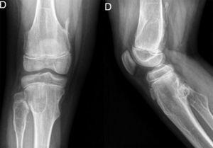 Radiografía en proyección AP y lateral. Exostosis óseas sésiles que representan osteocondromas en contexto de exostosis hereditaria múltiple.