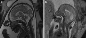 Disrafia espinal, con fosa posterior normal y espacio subaracnoideo de amplitud normal en imágenes sagital T2w HASTE (A) y con espacio subaracnoideo disminuido (B) asociado a descenso de amígdalas cerebelosas a través del foramen magno.
