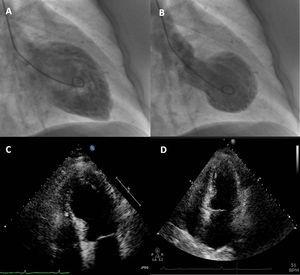 Contrast left ventriculography: diastolic (A) and systolic (B) frames showing motion abnormalities of the mid and apical segments. Transthoracic echocardiogram in 4-chamber apical view (systolic frames) revealing akinesia of mid-apical segments and apical ballooning (C), no longer present at discharge (D).