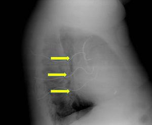 Radiografia de tórax perfil esquerdo. As setas mostram os eletrócateteres subcutâneos do array.
