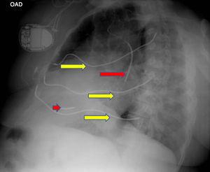 Radiografia de tórax perfil direito. As setas amarelas mostram os eletrocateteres subcutâneos do array e as vermelhas o eletrocater intracavitário.