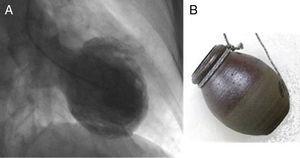 A) morfologia cardíaca em sístole numa doente com MT na ventriculografia com FEVE 27%. B) Takotsubo = armadilha para captura de polvos (tako) em forma de pote (tsubo).