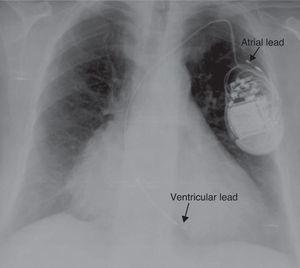 Twiddler Syndrome As A Cause Of Defibrillator Malfunction 