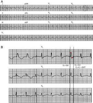 Aplicação do critério vi/vt. A figura A mostra um traçado de taquicardia de QRS largos de 12 derivações. A vi é medida numa derivação onde está presente um QRS bi ou multifásico e a velocidade de ativação é a mais rápida. Nessa derivação é escolhido um complexo QRS onde o início e final do QRS sejam perfeitamente visíveis. B – Linhas verticais marcam o início e o final do QRS escolhido e pequenas estrelas marcam os 40ms iniciais e terminais do QRS. Durante os 40ms iniciais do QRS, o impulso deslocou‐se verticalmente 0,8mV, e assim vi=0,8. Durante os 40ms finais o impulso deslocou‐se verticalmente 0,2mV e assim vt=0,2mV. Assim, a relação vi/vt sugere o diagnóstico de TSV (Fonte: Vereckei et al.18).