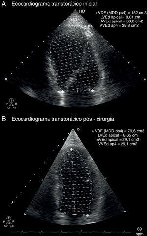 Imagens do ecocardiograma transtorácico, plano apical de quatro câmaras em telediástole, que mostram a redução do volume telediastólico do ventrículo esquerdo: A) antes da terapêutica; B) dois meses pós‐cirurgia.