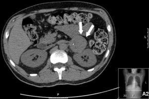 TAC abdominal: massa sólida hipodensa em contiguidade com a glândula suprarrenal esquerda (setas).