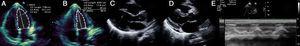 Ecocardiograma transtorácico que mostra recuperação da função biventricular. A e B: avaliação da função ventricular esquerda pelo método de Simpson; C e D: paraesternal longo eixo em diástole e sístole, respetivamente; observa‐se redução da hipertrofia das paredes do ventrículo esquerdo e do derrame pericárdico; E: avaliação da função do ventrículo direito pelo cálculo do TAPSE.