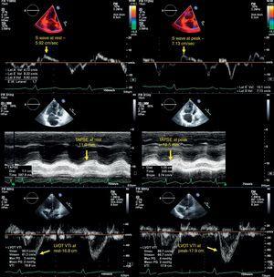 Echocardiographic parameters of right ventricular contractile reserve in a pulmonary hypertension patient at rest (left) and at peak exercise (right); top – S-wave velocity; middle – <span class=