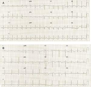 (A) ECG on admission showing ST-segment elevation in precordial leads; (B) ECG on the third day of hospitalization demonstrating T-wave inversion in precordial leads.