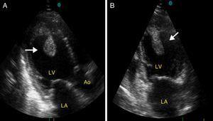 (A) Apical 3-chamber view showing a large thrombus attached to the apex (arrow); (B) apical 2-chamber view showing the thrombus protruding into the left ventricular cavity (arrow). Ao; aorta; LA; left atrium; LV: left ventricle.