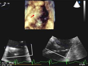 Real-time three-dimensional transesophageal echocardiography: view of the tricuspid valve in diastole from the right atrium, revealing adherence of the pacing lead to the septal leaflet (arrow).