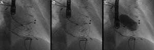 Angiographic images of percutaneous tricuspid valvuloplasty: (A) pigtail catheter across the tricuspid valve; (B) Amplatz Super Stiff guidewire across the valve; (C) balloon inflation.