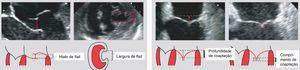 Critérios anatómicos do MitraClip além duma área mitral ≥4,0cm2: hiato de flail <10mm; largura de flail <15mm; profundidade de coaptação <11mm; comprimento de coaptação >2mm (adaptado com permissão do Transesophageal Echo Acquisition Guide – Abbott Vascular).