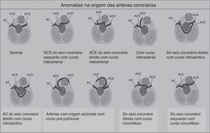 Representação esquemática das anomalias congénitas na origem das artérias coronárias. AC: artéria circunflexa; <span class=