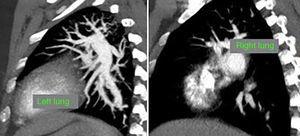 Computed tomography angiography showing involvement of distal left segmental branches and distal right segmental branches of the superior, mid and inferior arteries.