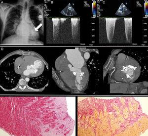 Panel A: Chest X-ray depicting left ventricular calcification (arrow). Panels B and C: Continuous-wave Doppler echocardiographic evaluation showing intraventricular gradient and severe pulmonary hypertension respectively. Panel D: Cardiac-CT showing calcification of the basal anteroseptal and basal inferior left ventricular walls. Panel E: Endomyocardial biopsy depicting normal myocardium surrounded by foci of endomyocardial fibrosis.