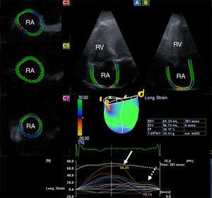 Images from the three-dimensional speckle-tracking echocardiography-derived full-volume dataset. Apical 4-chamber (A) and 2-chamber (B) views and parasternal short-axis views at basal (C3), mid-atrial (C5) and superior (C7) right atrial level are displayed. Right atrial volumetric data and three-dimensional right atrial cast together with time-global volume (dashed line) and segmental time-longitudinal strain (colored lines) curves are also demonstrated. The method presented allows automatic measurement of peak strains (white arrow) and strains at atrial contraction (dashed arrow). EDV: end-diastolic volume; ESV: end-systolic volume; EF: ejection fraction; RA: right atrium; RV: right ventricle.