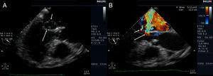 Transesophageal echocardiogram (3-chamber view). (A) Ruptured aneurysm of the anterior mitral valve leaflet. The long arrow points to the entry site and the small arrow points to the exit site of the aneurysm; (B) color Doppler image showing two mitral regurgitation jets: a small jet through the leaflet coaptation point (small arrow) and a much more significant one through the aneurysm (long arrow).