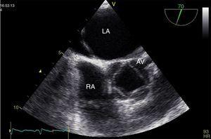 Transesophageal echocardiography, short-axis view during systole, showing quadricuspid aortic valve. AV: aortic valve; LA: left atrium; RA: right atrium.