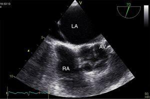 Transesophageal echocardiography, short-axis view at end-systole, showing quadricuspid aortic valve. AV: aortic valve; LA: left atrium; RA: right atrium.