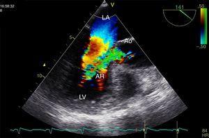 Transesophageal echocardiography, long-axis view during diastole, showing aortic regurgitation. AR: aortic regurgitation; Ao: aortic valve; LA: left atrium; LV: left ventricle.