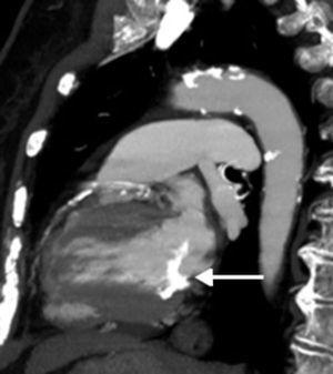 Computed tomography, reformatted oblique sagittal view, depicting a dense calcified mass (white arrow).