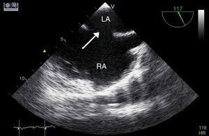 Transesophageal echocardiographic image of atrial septal defect (arrow). LA: left atrium; RA: right atrium.