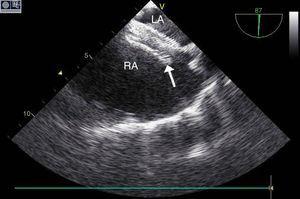 Transesophageal echocardiographic image of septal occluder device (arrow) after implantation. LA: left atrium; RA: right atrium.