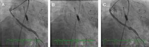 Case 1. (A) The right anterior oblique caudal view reveals the saphenous vein graft (<span class=