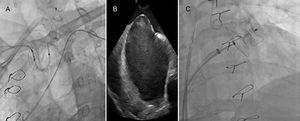 Device implantation using a cerebral protection system guided by intracardiac echocardiography (ICE). (A) Fluoroscopy showing the cerebral protection system (Sentinel™, Claret Medical). (B) Transseptal puncture guided by ICE. (C) Fluoroscopy showing the device (Amulet™ St. Jude Medical; size 28 mm) implantation.