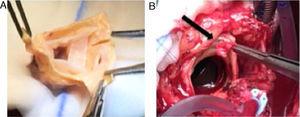 (A) Preparation of an aortic valve homograft prior to implantation during surgery. (B) Visualization of the vegetation removed from the aortic prosthesis.