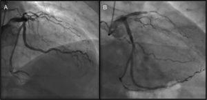 Coronary angiography (Panel A: right cranial view; Panel B: right caudal view) showing LAD occlusion prior to the CABG.